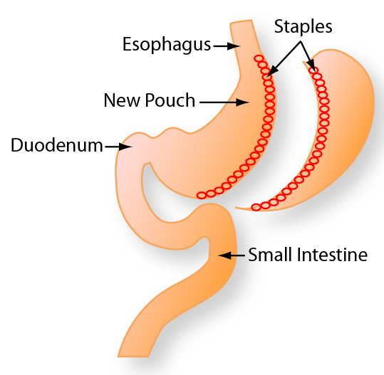 Gastric Sleeve Costs and Insurance Guide Bariatric Journal