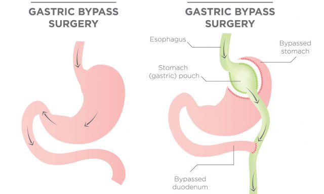 BCBS of Alabama Bariatric Surgery Requirements, Options BCBS of Alabama Bariatric Surgery Requirements, Options